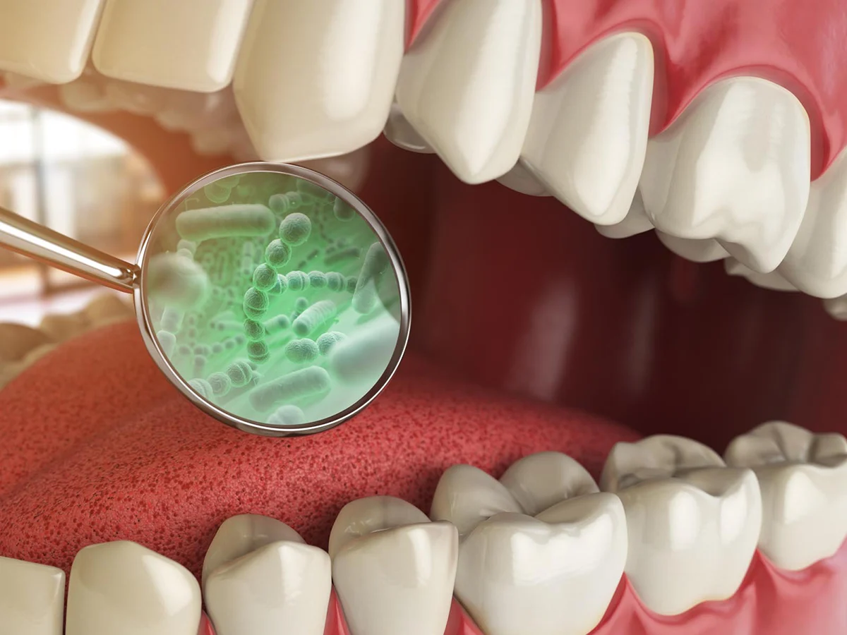Halitosis (Bad Breath) Treatment