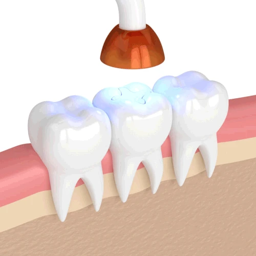 Tooth Fillings & Sealants